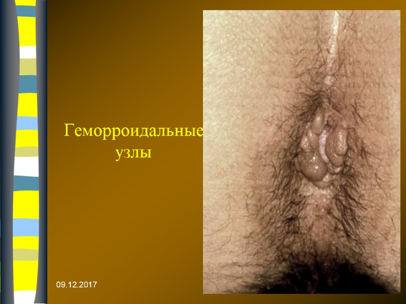 09.12.2017 Геморроидальные узлы